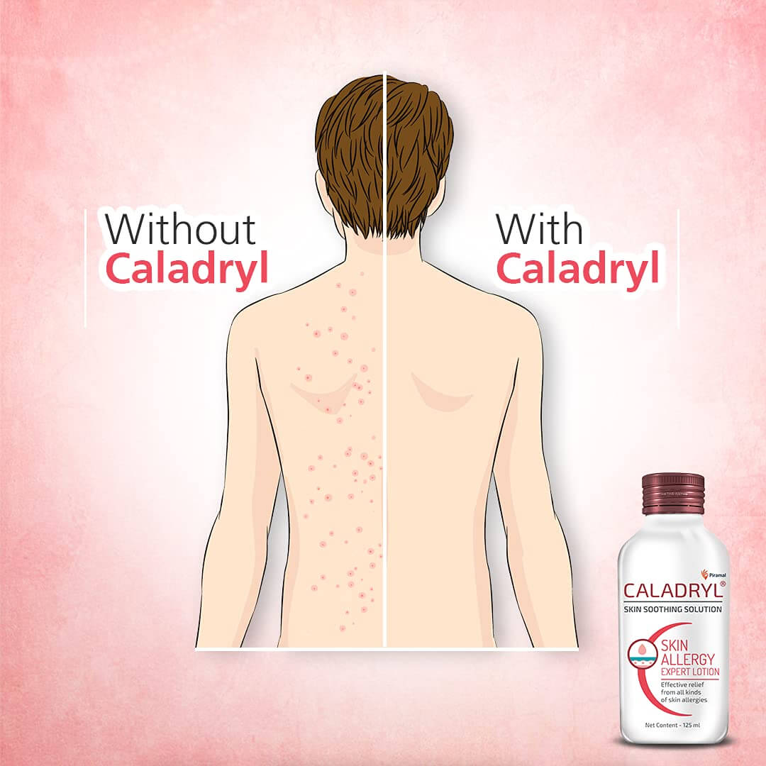 Caladryl Skin Allergy Solution