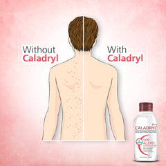 Caladryl Skin Allergy Solution
