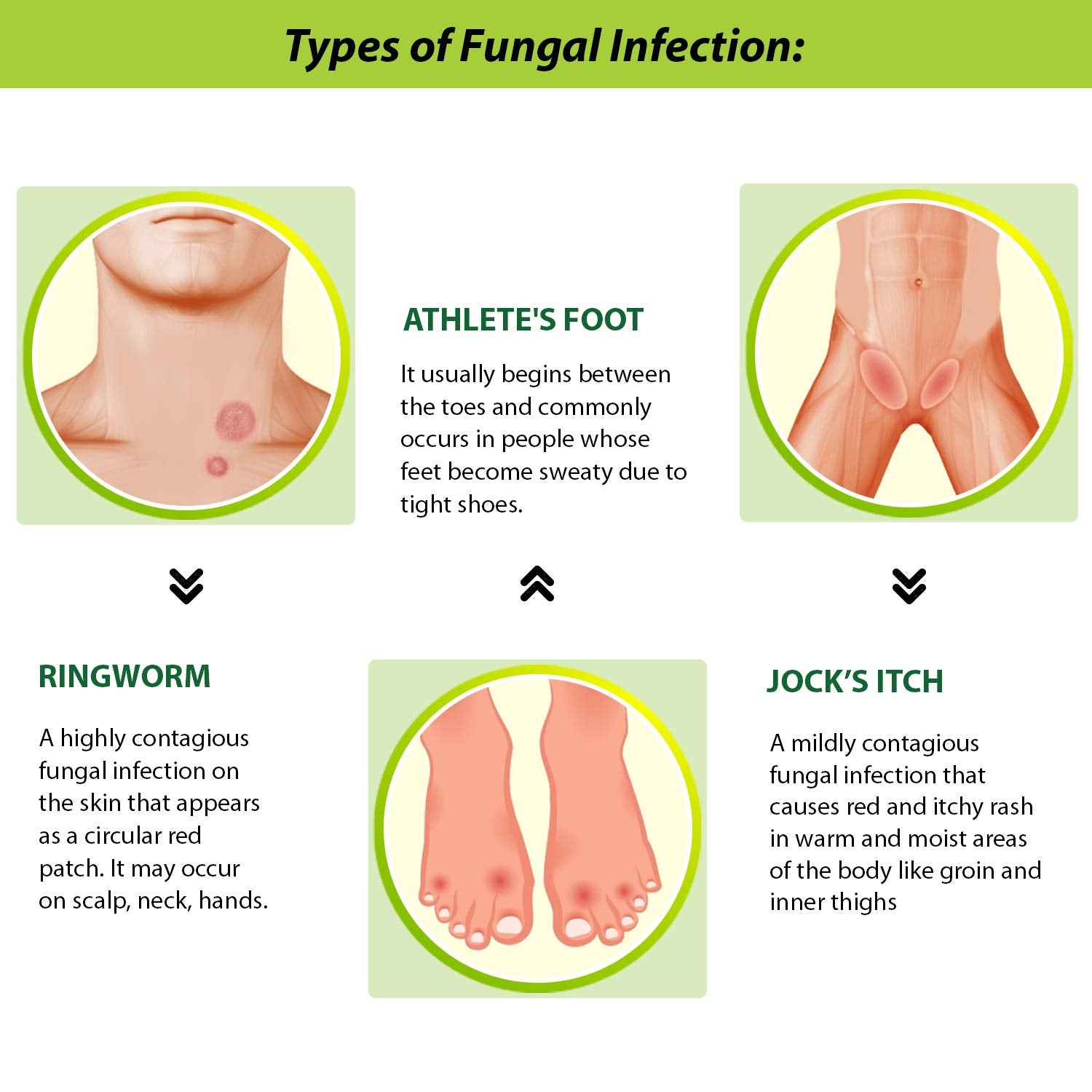 Fungal infection infographic