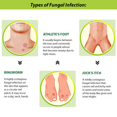 Fungal infection infographic